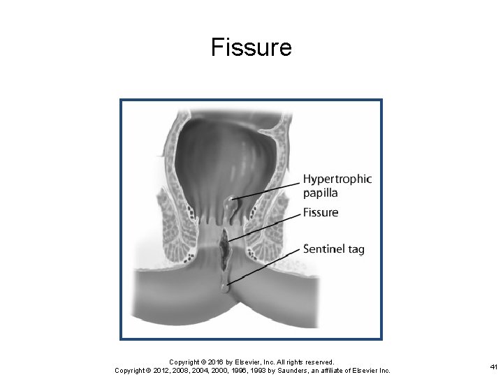 Fissure Copyright © 2016 by Elsevier, Inc. All rights reserved. Copyright © 2012, 2008,