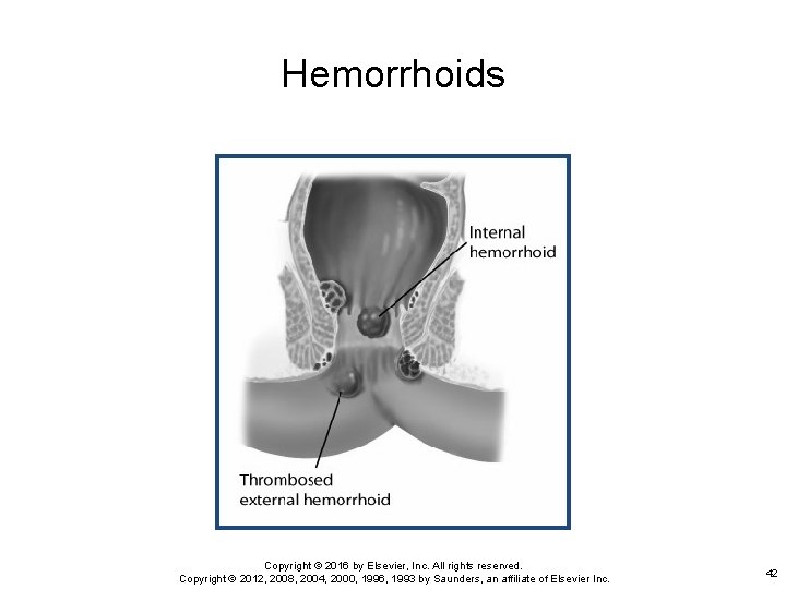Hemorrhoids Copyright © 2016 by Elsevier, Inc. All rights reserved. Copyright © 2012, 2008,