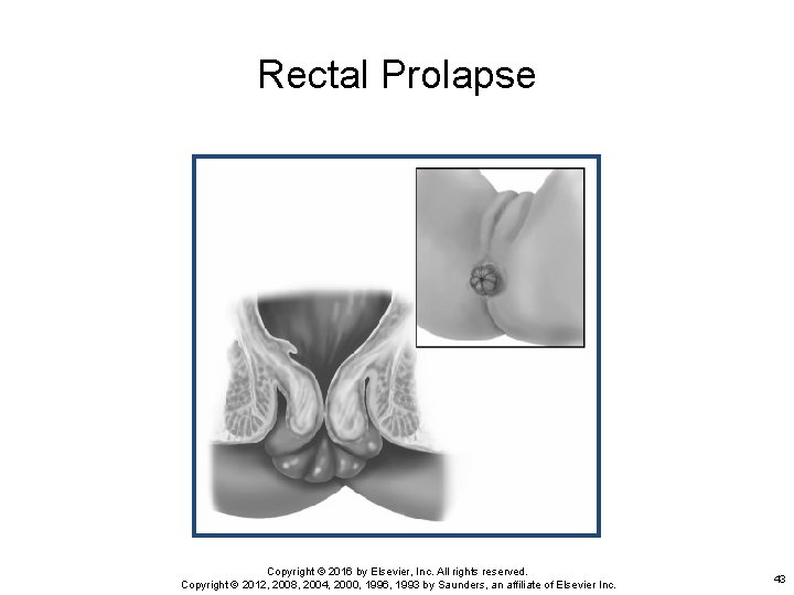 Rectal Prolapse Copyright © 2016 by Elsevier, Inc. All rights reserved. Copyright © 2012,