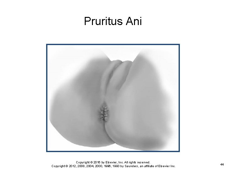 Pruritus Ani Copyright © 2016 by Elsevier, Inc. All rights reserved. Copyright © 2012,