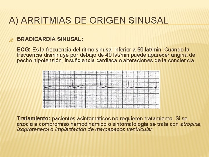 A) ARRITMIAS DE ORIGEN SINUSAL BRADICARDIA SINUSAL: ECG: Es la frecuencia del ritmo sinusal