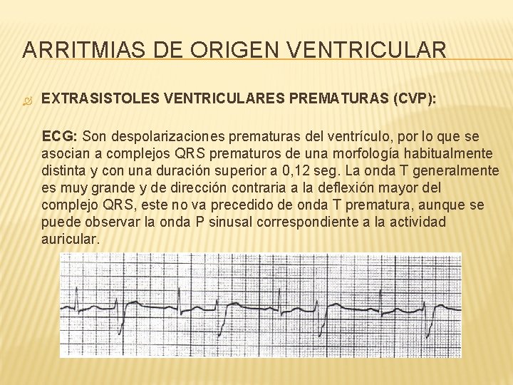 ARRITMIAS DE ORIGEN VENTRICULAR EXTRASISTOLES VENTRICULARES PREMATURAS (CVP): ECG: Son despolarizaciones prematuras del ventrículo,
