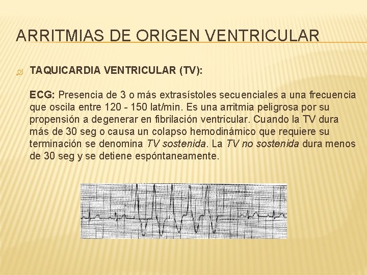 ARRITMIAS DE ORIGEN VENTRICULAR TAQUICARDIA VENTRICULAR (TV): ECG: Presencia de 3 o más extrasístoles