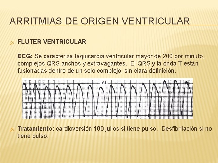 ARRITMIAS DE ORIGEN VENTRICULAR FLUTER VENTRICULAR ECG: Se caracteriza taquicardia ventricular mayor de 200