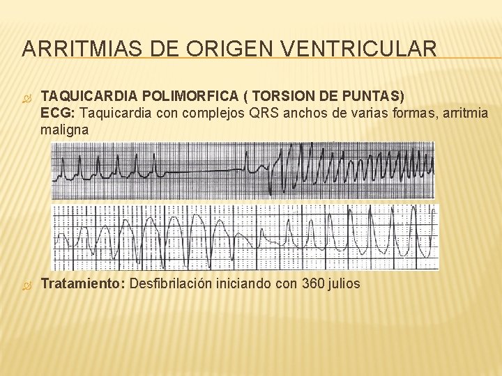 ARRITMIAS DE ORIGEN VENTRICULAR TAQUICARDIA POLIMORFICA ( TORSION DE PUNTAS) ECG: Taquicardia con complejos