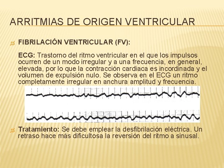 ARRITMIAS DE ORIGEN VENTRICULAR FIBRILACIÓN VENTRICULAR (FV): ECG: Trastorno del ritmo ventricular en el