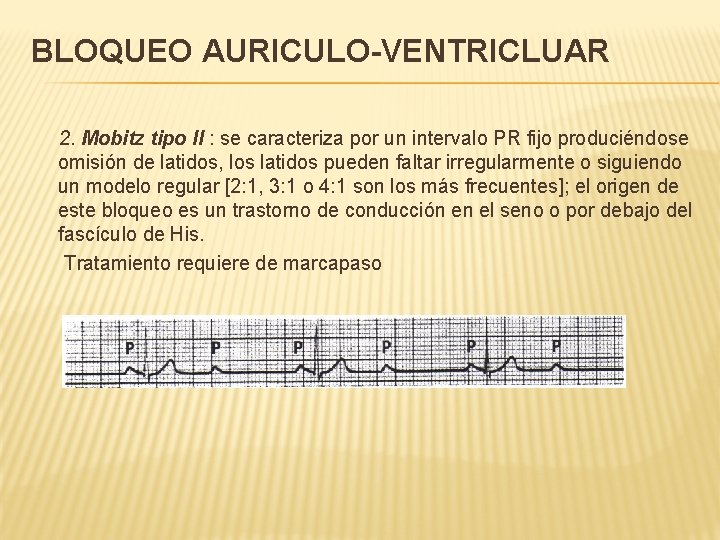 BLOQUEO AURICULO-VENTRICLUAR 2. Mobitz tipo II : se caracteriza por un intervalo PR fijo