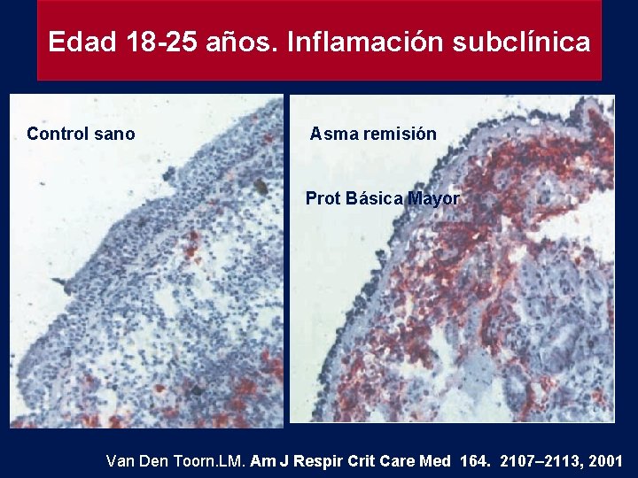 Edad 18 -25 años. Inflamación subclínica Control sano Asma remisión Prot Básica Mayor Van