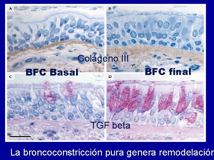 Colágeno III BFC Basal BFC final TGF beta La broncoconstricción pura genera remodelación 