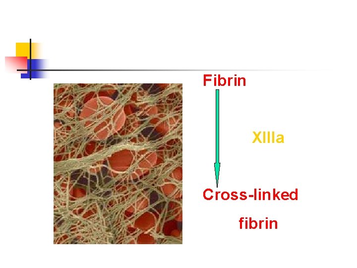 Fibrin XIIIa Cross-linked fibrin 