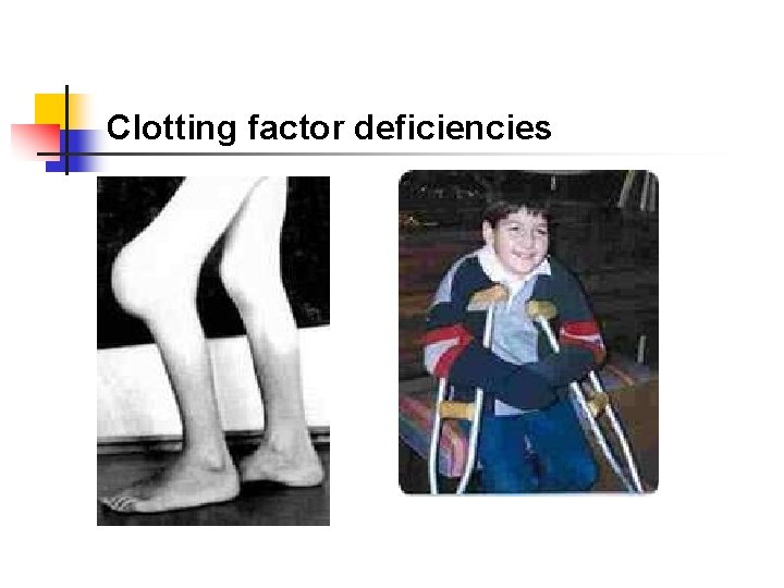 Clotting factor deficiencies 