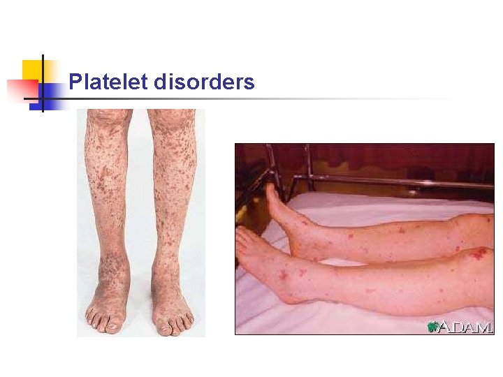 Platelet disorders 