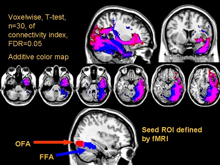 Voxelwise, T-test, n=30, of connectivity index, FDR=0. 05 Additive color map Seed ROI defined