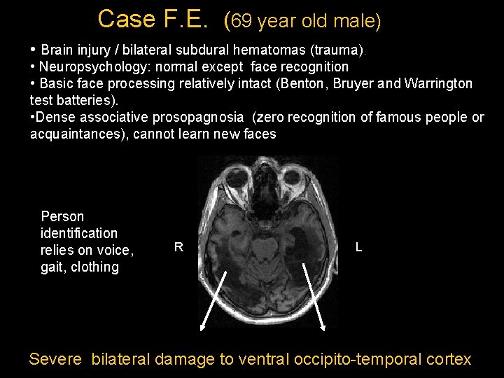 Case F. E. (69 year old male) • Brain injury / bilateral subdural hematomas