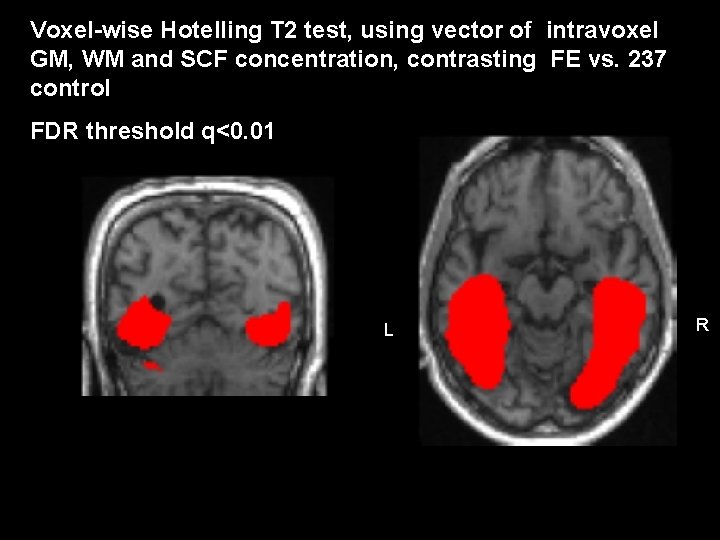 Voxel-wise Hotelling T 2 test, using vector of intravoxel GM, WM and SCF concentration,