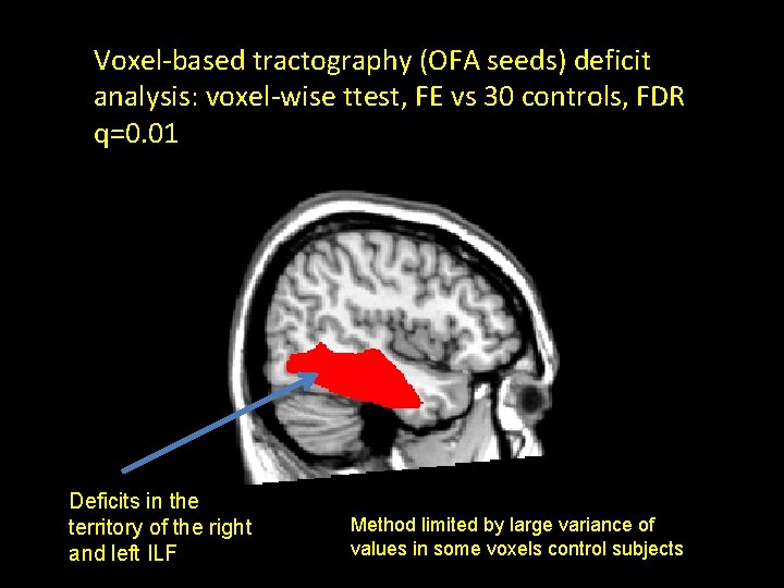 Voxel-based tractography (OFA seeds) deficit analysis: voxel-wise ttest, FE vs 30 controls, FDR q=0.