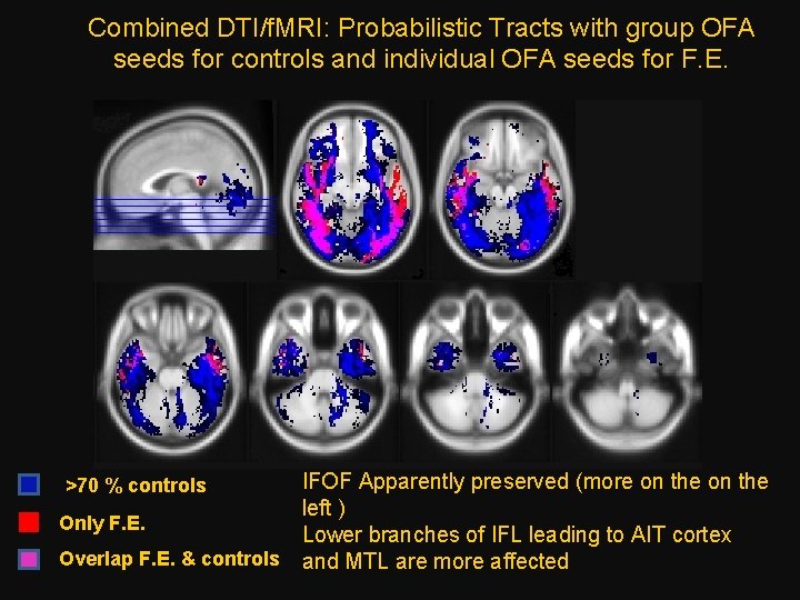 Combined DTI/f. MRI: Probabilistic Tracts with group OFA seeds for controls and individual OFA