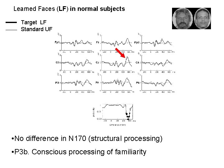 Learned Faces (LF) in normal subjects. Target LF Standard UF • No difference in