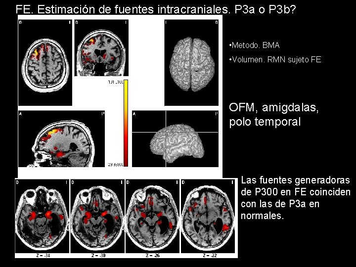 FE. Estimación de fuentes intracraniales. P 3 a o P 3 b? • Metodo.