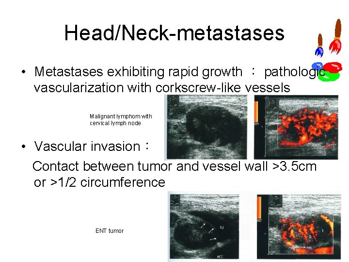 Head/Neck metastases • Metastases exhibiting rapid growth : pathologic vascularization with corkscrew like vessels Head/Neck metastases • Metastases exhibiting rapid growth : pathologic vascularization with corkscrew like vessels