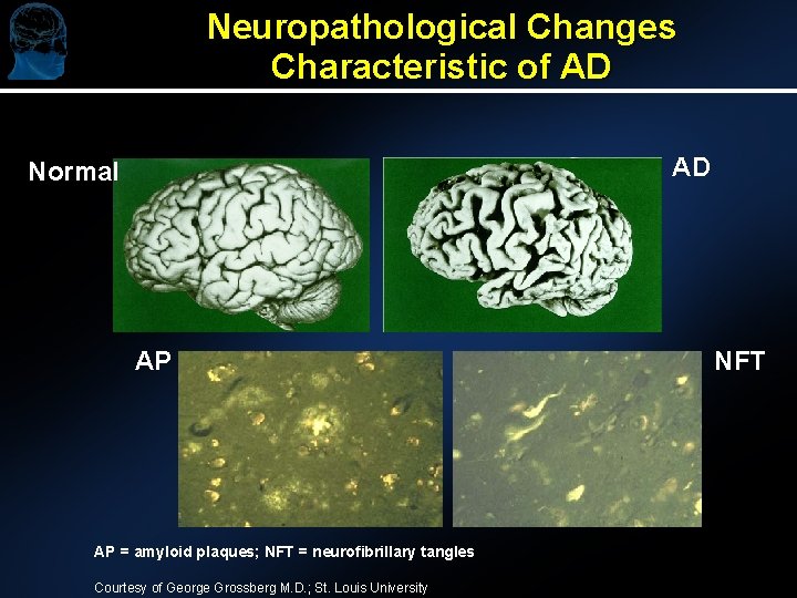 Neuropathological Changes Characteristic of AD AD Normal AP AP = amyloid plaques; NFT = Neuropathological Changes Characteristic of AD AD Normal AP AP = amyloid plaques; NFT =