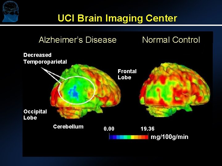 UCI Brain Imaging Center Alzheimer’s Disease Normal Control Decreased Temporoparietal Frontal Lobe Occipital Lobe