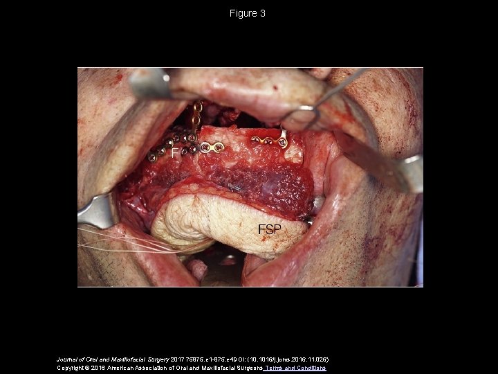 Figure 3 Journal of Oral and Maxillofacial Surgery 2017 75875. e 1 -875. e