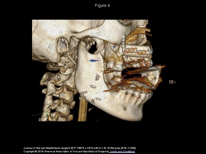 Figure 4 Journal of Oral and Maxillofacial Surgery 2017 75875. e 1 -875. e