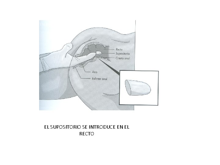 EL SUPOSITORIO SE INTRODUCE EN EL RECTO 