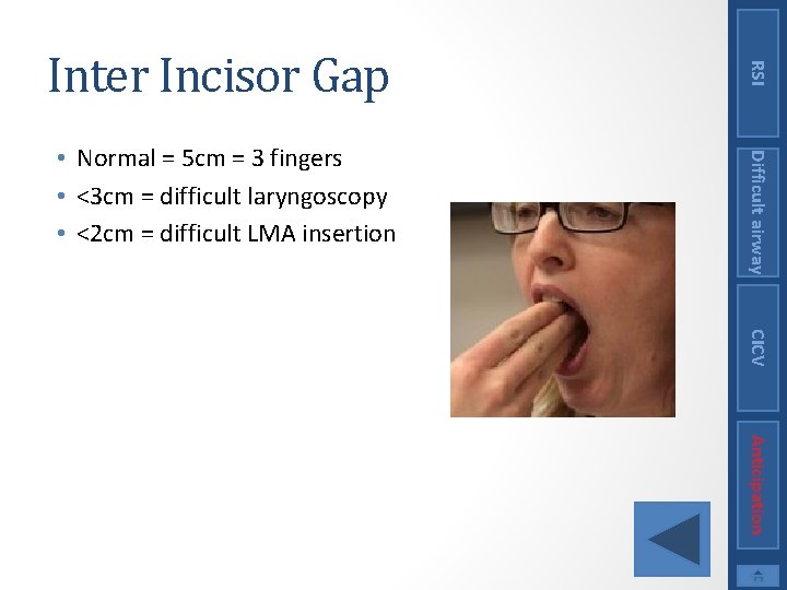 Difficult airway • Normal = 5 cm = 3 fingers • <3 cm =