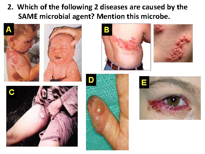 2. Which of the following 2 diseases are caused by the SAME microbial agent?