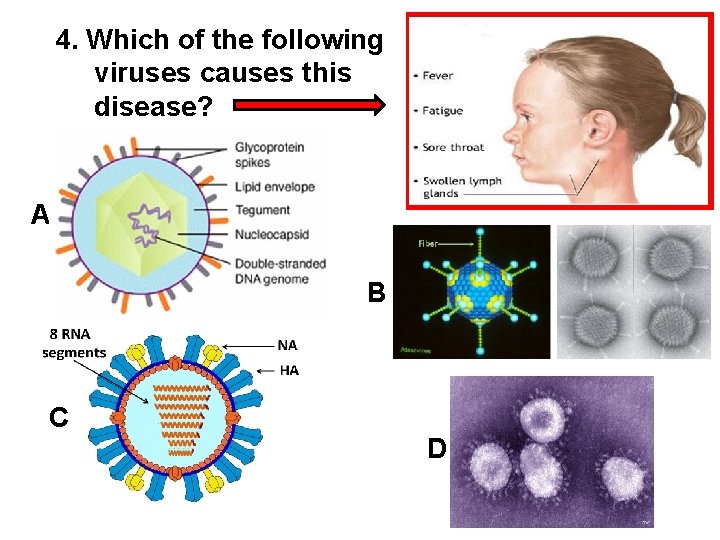 4. Which of the following viruses causes this disease? A B C D 