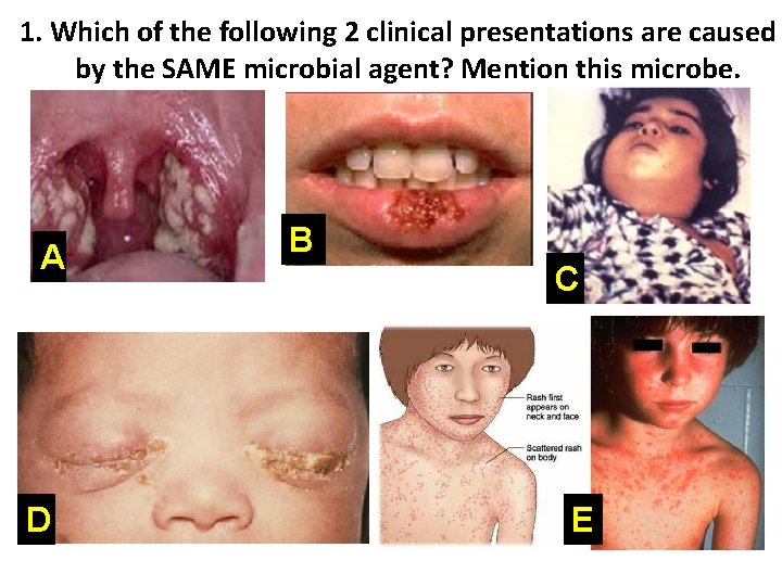 1. Which of the following 2 clinical presentations are caused by the SAME microbial