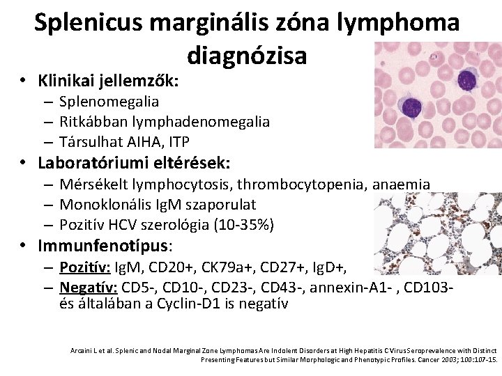 Splenicus marginális zóna lymphoma diagnózisa • Klinikai jellemzők: – Splenomegalia – Ritkábban lymphadenomegalia –