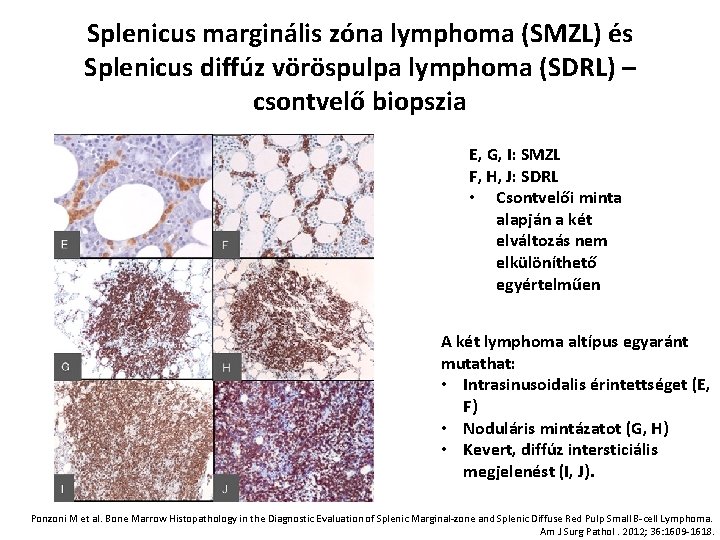 Splenicus marginális zóna lymphoma (SMZL) és Splenicus diffúz vöröspulpa lymphoma (SDRL) – csontvelő biopszia