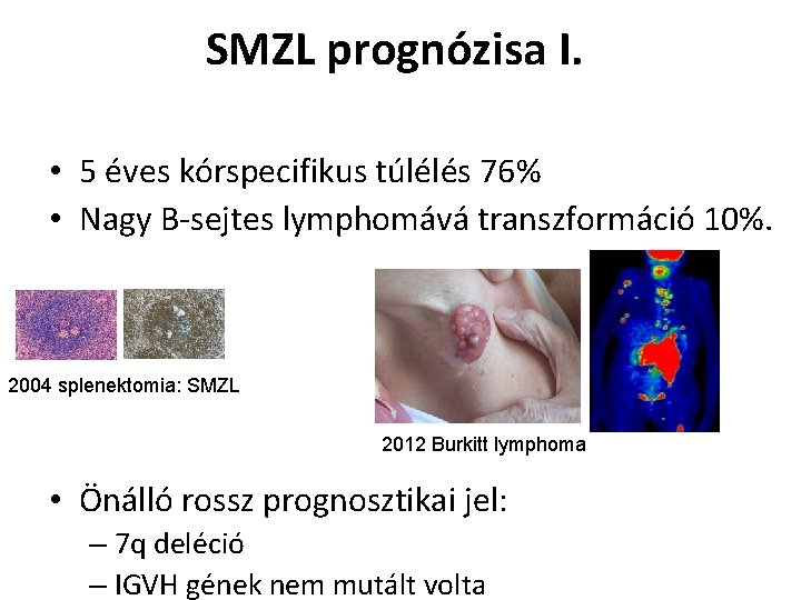 SMZL prognózisa I. • 5 éves kórspecifikus túlélés 76% • Nagy B-sejtes lymphomává transzformáció