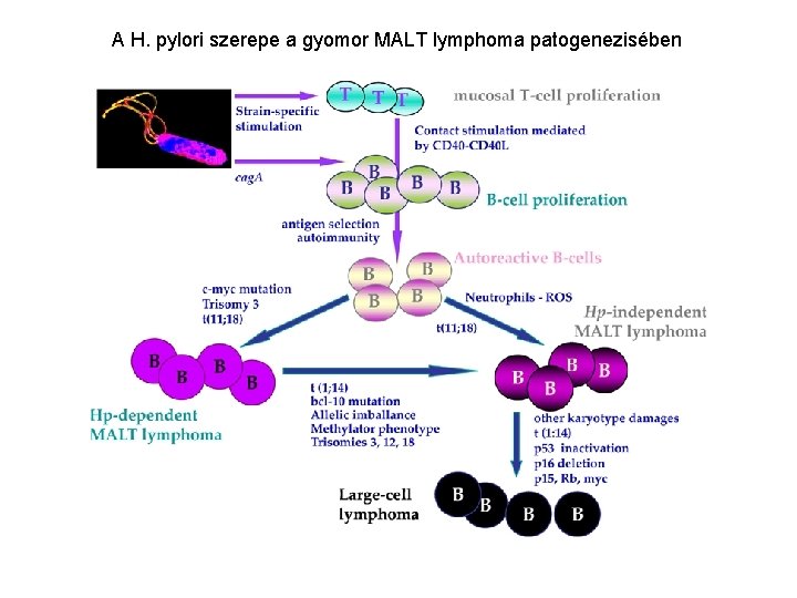 A H. pylori szerepe a gyomor MALT lymphoma patogenezisében 