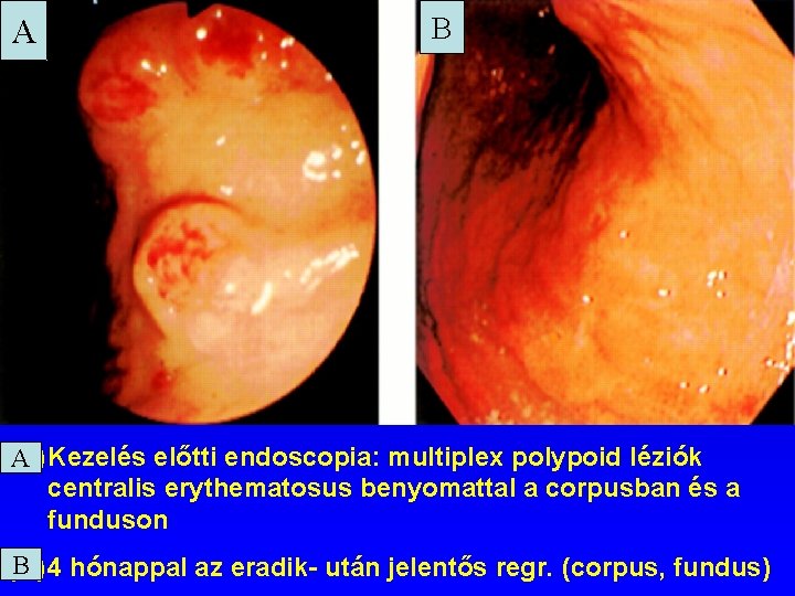 A B (A) A Kezelés előtti endoscopia: multiplex polypoid léziók centralis erythematosus benyomattal a