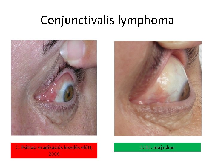 Conjunctivalis lymphoma C. Psittaci eradikációs kezelés előtt, 2006 2012. májusban 
