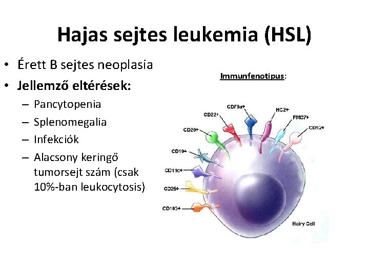 Hajas sejtes leukemia (HSL) • Érett B sejtes neoplasia • Jellemző eltérések: – –