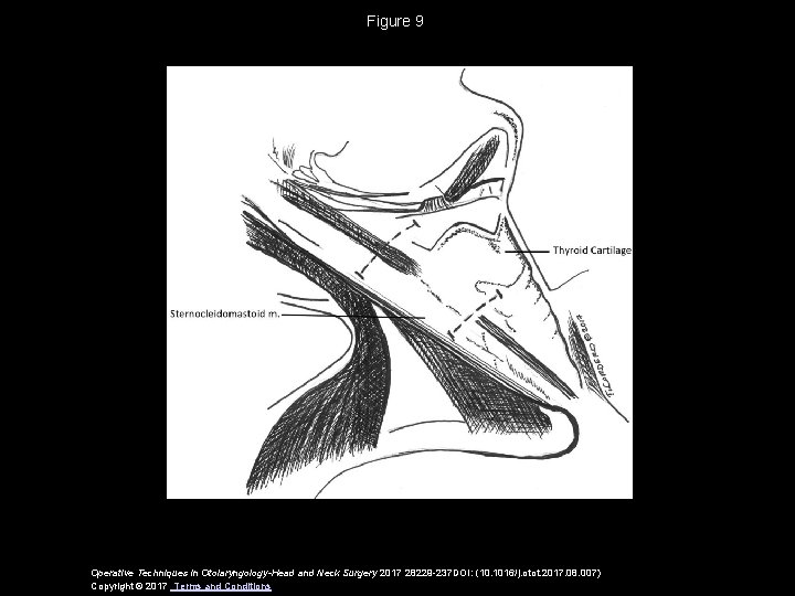 Figure 9 Operative Techniques in Otolaryngology-Head and Neck Surgery 2017 28229 -237 DOI: (10.