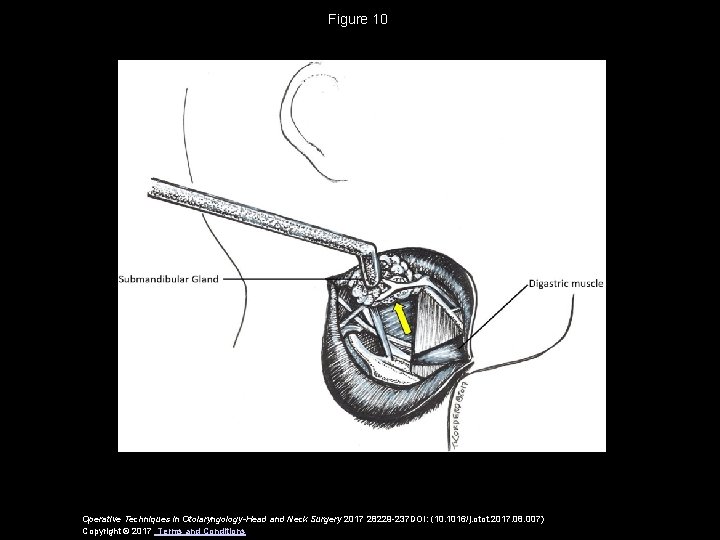 Figure 10 Operative Techniques in Otolaryngology-Head and Neck Surgery 2017 28229 -237 DOI: (10.