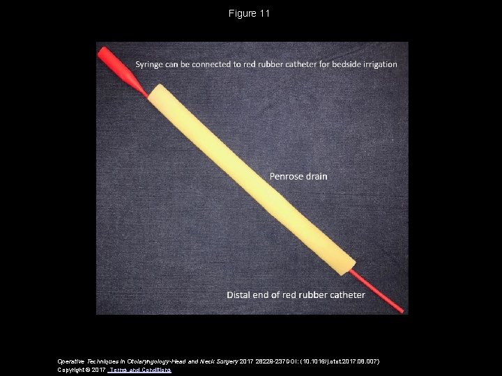 Figure 11 Operative Techniques in Otolaryngology-Head and Neck Surgery 2017 28229 -237 DOI: (10.