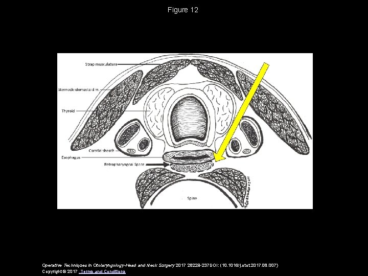 Figure 12 Operative Techniques in Otolaryngology-Head and Neck Surgery 2017 28229 -237 DOI: (10.