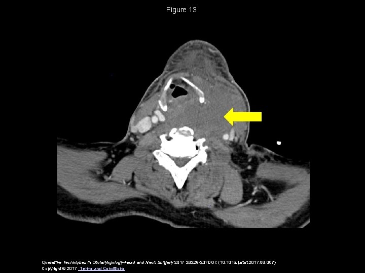 Figure 13 Operative Techniques in Otolaryngology-Head and Neck Surgery 2017 28229 -237 DOI: (10.