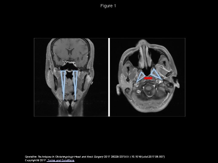 Figure 1 Operative Techniques in Otolaryngology-Head and Neck Surgery 2017 28229 -237 DOI: (10.