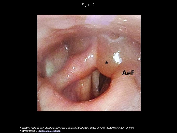 Figure 2 Operative Techniques in Otolaryngology-Head and Neck Surgery 2017 28229 -237 DOI: (10.