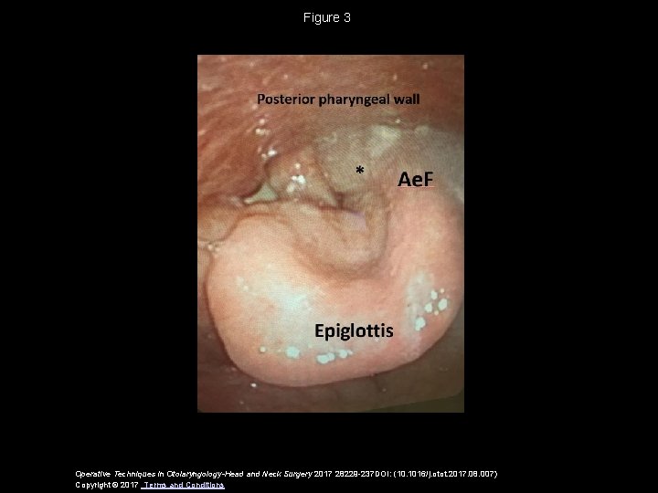 Figure 3 Operative Techniques in Otolaryngology-Head and Neck Surgery 2017 28229 -237 DOI: (10.