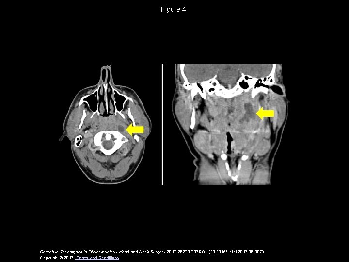 Figure 4 Operative Techniques in Otolaryngology-Head and Neck Surgery 2017 28229 -237 DOI: (10.