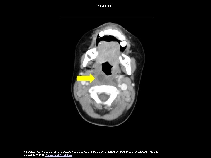 Figure 5 Operative Techniques in Otolaryngology-Head and Neck Surgery 2017 28229 -237 DOI: (10.